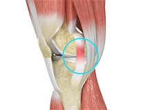 MCL Sprains